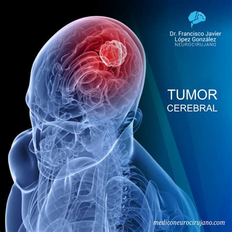 Medico Neurocirujano Dr Francisco J Lopez Gonzalez Síntomas Del