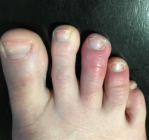 Red Swollen Toes Chillblains Help Please Raynauds Phenomenon