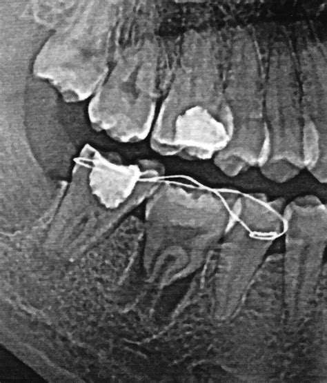 Immediate Autotransplantation Of Mandibular Third Molar In China Oral