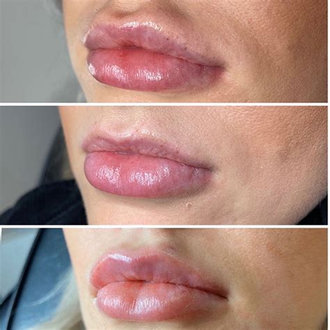 Lip Mesotherapy The Latest Needle Free Alternative To Lip Fillers