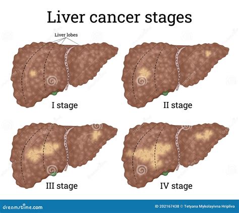Top 93 Pictures Early Signs Of Liver Cancer In Females Latest