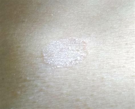 Dry Flaky Patch Of Skin