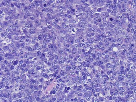 Large Cell Lymphoma In Cats Treatment