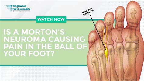 Houston Morton S Neuroma Ball Of Foot Treatment Tanglewood Foot Specialists