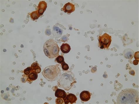 Mesothelioma is a rare neoplasm of the serosal membranes. Malignant mesothelioma | Eurocytology