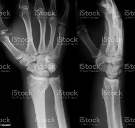 Download Xray Image Of Wrist Joint Ap And Lateral View Stock Photo Istock