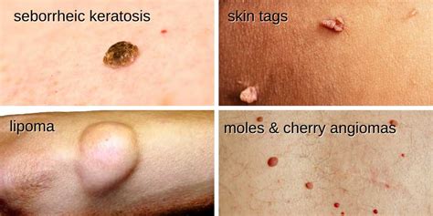 Benign Andor Malignant Lesions Cibolo Creek Dermatology Group