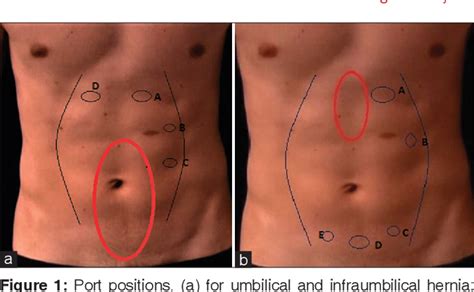 Figure 1 From Extended Totally Extraperitoneal Repair Etep For