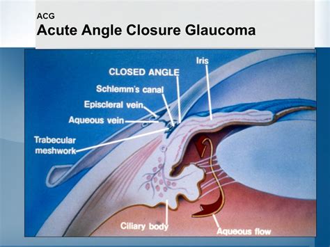 Acute Angle Closure Acute Angle Closure Glaucoma Aacg Background