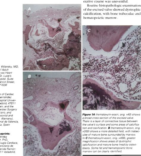 Osseous Metaplasia And Hematopoietic Bone Marrow In A Calcified Aortic