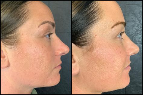 Microneedling Before And After 05 Bella Vi