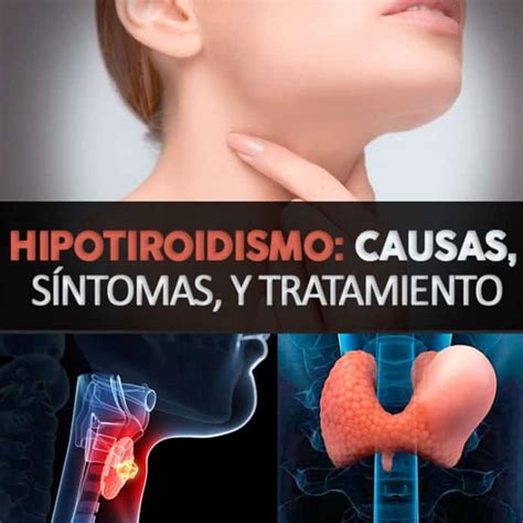 Hipotiroidismo Qu Es Causas S Ntomas Y Tratamiento La Gu A De