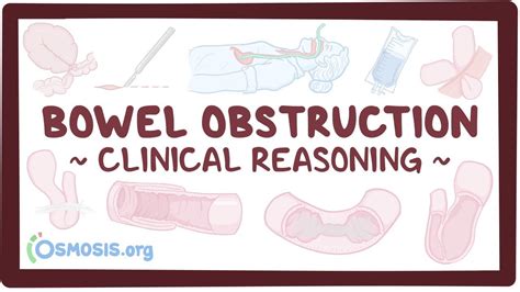 Bowel Obstruction Clinical Video And Anatomy Osmosis