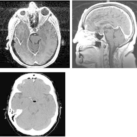 Preoperative T1 Weighted Gadolinium Enhanced Axial And Sagittal Images