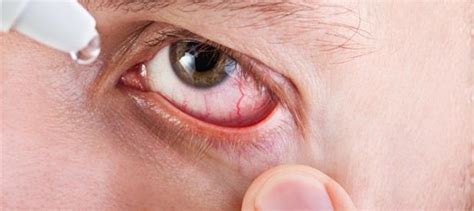 Eye Infections