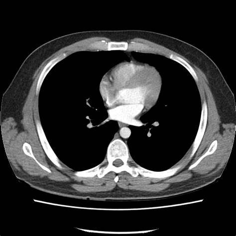 Normal Ct Chest Image