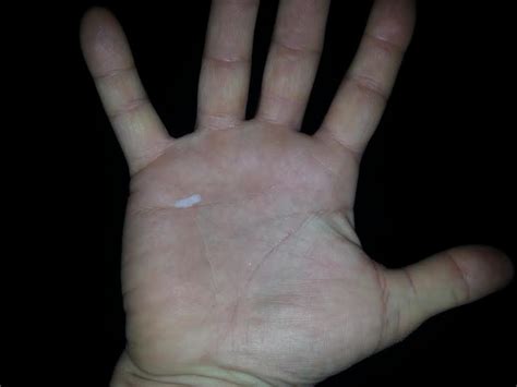 Why do i get calluses on my hands when i lift weights? Tips for Avoiding Blisters and Developing Healthy Calluses ...