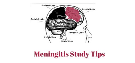 Meningitis Explained Nursing School Success