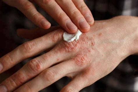 Qué Es La Dermatitis Atópica Y Cómo Debemos Tratarla Bepanthol®