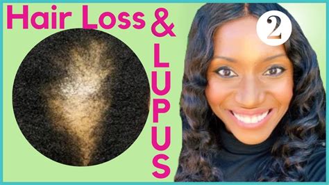 Lupus And Hair Loss Pt Lupuswarrior Lupusawarenessmonth Youtube