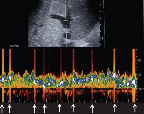 Us Of Right Upper Quadrant Pain In The Emergency Department Diagnosing