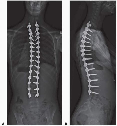 Posterior Spinal Fusion For Idiopathic Scoliosis Musculoskeletal Key