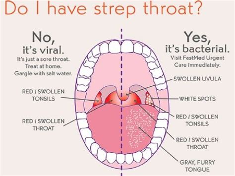Strep Throat Throat Remedies Strep Throat Remedies Strep Throat