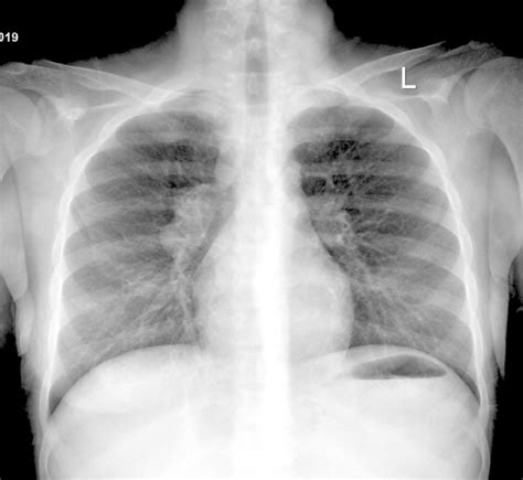 Chest X Ray Posteroanterior View Showing Bulky Hilum On The Right Side