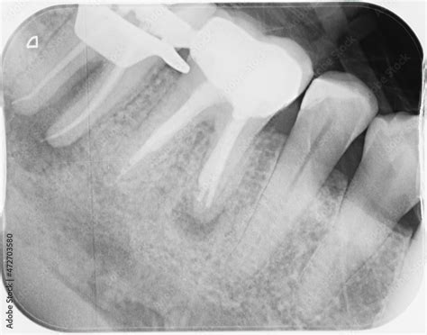 X Ray Of Four Human Teeth Two Molars Have Been Heavily Filled And Had Root Canal Treatments
