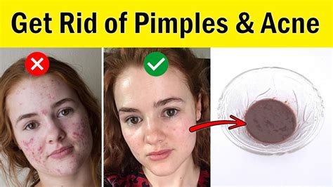 How To Get Rid Of Pimples And Acne On Face Naturally Home Remedies For