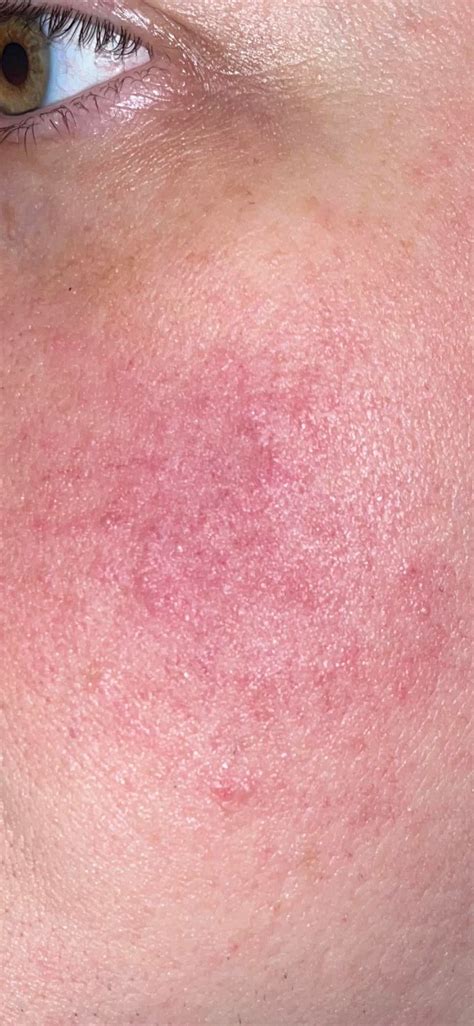 What Is This Psoriasis Rosacea 38f Rdiagnoseme