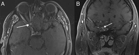 Cureus A Rare Case Of Optic Nerve Schwannoma Case Report And Review