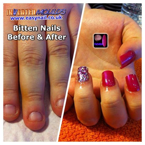 Acrylic Nails Bitten Nails Before And After Application Of Inverted