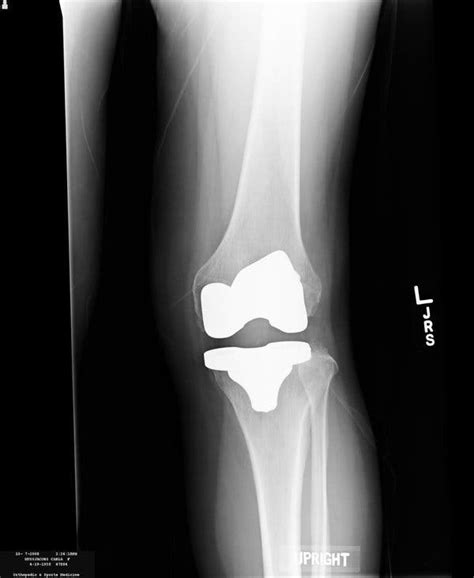 Knee Replacement Device Unapproved But Used In Surgery The New York Times