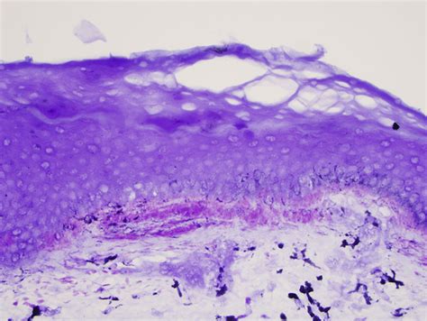 Lichen Amyloidosis Dermatopathology