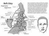 Facial Muscle Exercise For Bell''s Palsy Pictures
