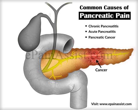 Function Of Pancreas And Common Causes Of Pancreatic Pain