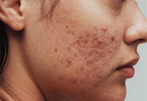 Acne Face Map The Cause Of These Breakouts Cleveland Clinic