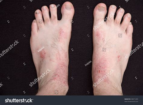 Dermatitis Pictures Feet