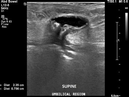 Ultrasound Of Hernias Umbilical Hernia Ultrasound Fluid Images And My