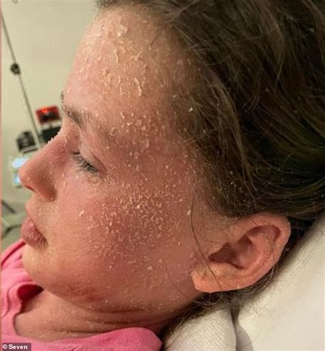 Bizarre Allergy Behind 11 Year Old Girls Debilitating Skin Condition