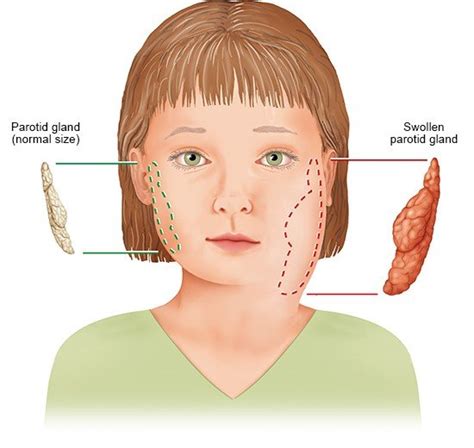 Mumps In Adults