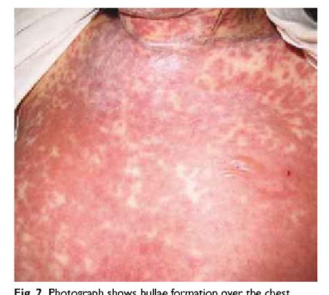 Figure 2 From Acute Generalised Exanthematous Pustulosis And Toxic