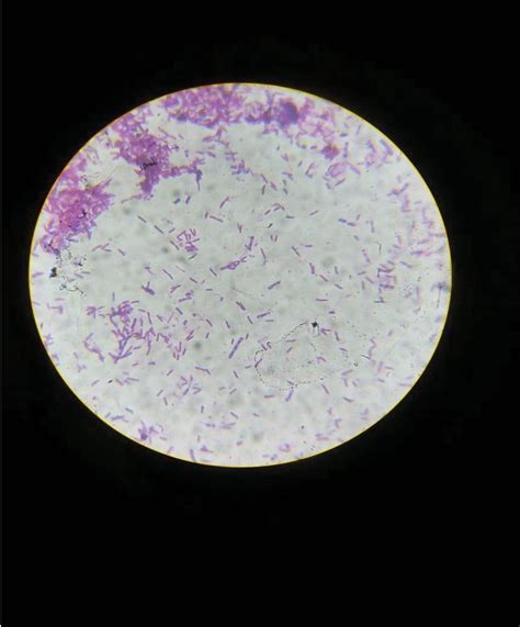 Cutaneous Anthrax In A Tribal Man A Case Report Postgraduate Medical