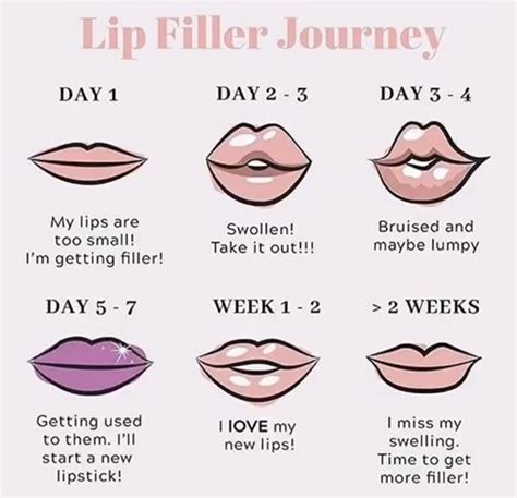 Lip Filler Journey Lip Fillers Lip Treatment Lip Injections