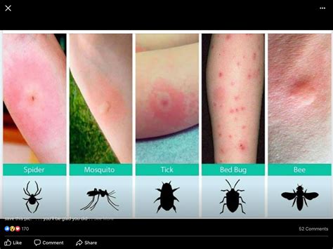 Pin By Kathy Blackmon On Likes Bed Bug Bites Bug Bites Bed Bugs