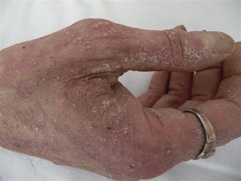 Crusted Scabies Complicates Etanercept Therapy In A Patient With Severe