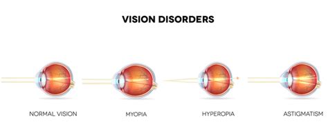 Lymphedema Distichiasis Syndrome Medlineplus Genetics