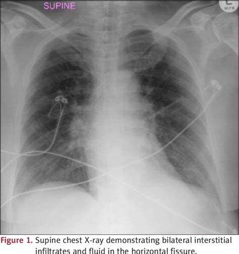 Figure 1 From Unusual Presentation Of Atrial Myxoma A Case Report And