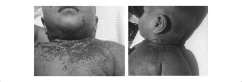 A Child With Atopic Dermatitis Complicated By Eczema Herpeticum On The